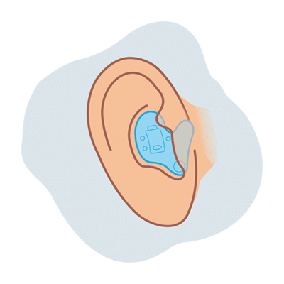 ITE hearing aid illustration