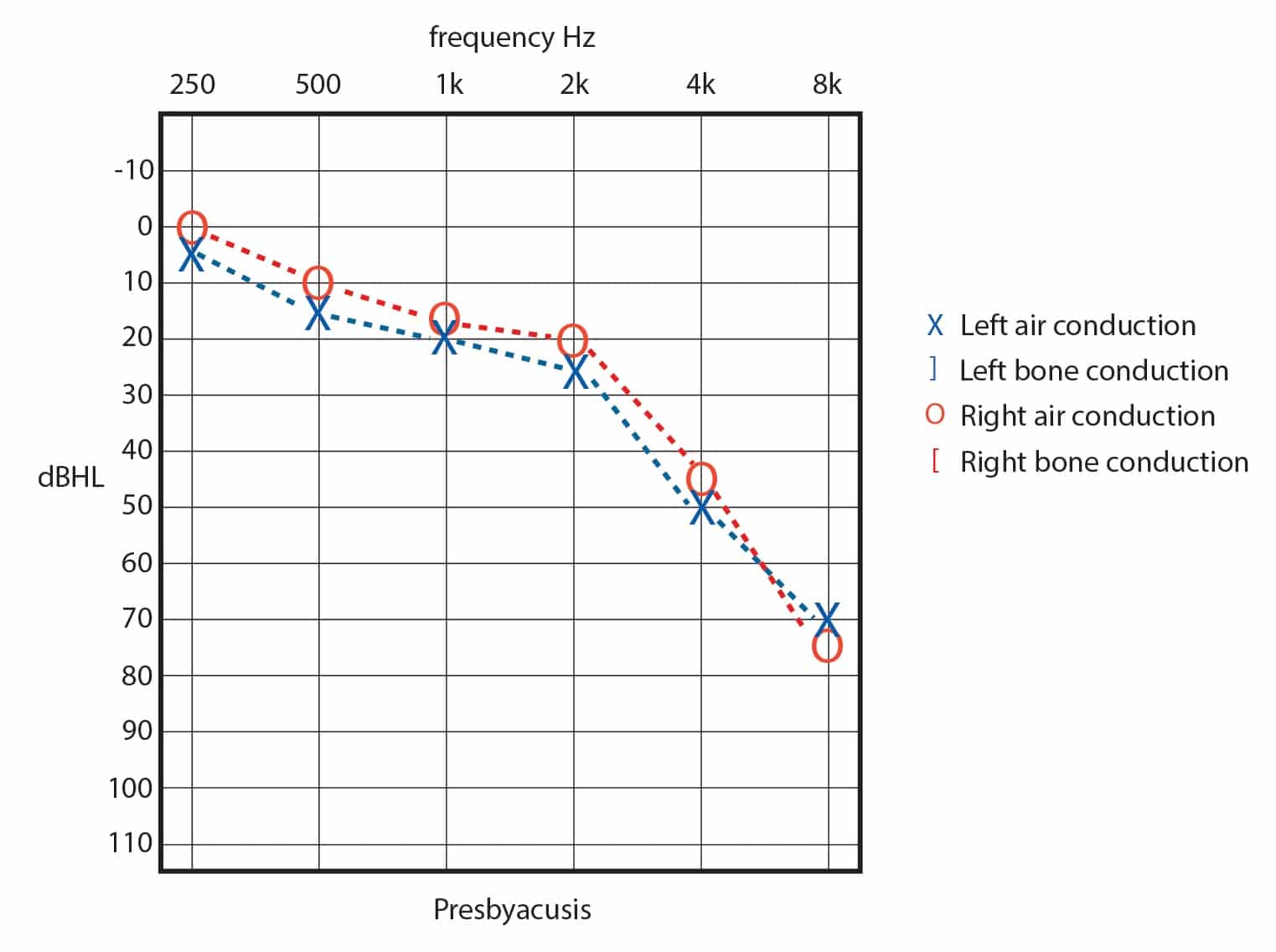 Audiogram of presbycusis showing a decrease in hearing ability from 250 hertz to 8,000 hertz